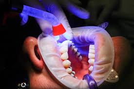 How to brush your teeth when you have braces. Best Way To Whiten Teeth After Braces Blue Ridge Orthodontics