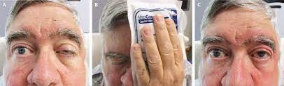 What are the symptoms of myasthenia gravis? Myasthenie Ganz Einfach Mit Dem Kuhlpack Diagnostizieren Springerlink