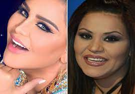 يمين، فوق، تحت، أمام (ومثلها قُدّام)، وراء (ومثلها خلف)، يسار (ومثلها شِمال)، تُبنى على الضمّ إذا قُطعت عن الإضافة. Ø¨Ø§Ù„ØµÙˆØ± Ø´ÙƒÙ„ Ø§Ù„Ù†Ø¬Ù…Ø§Øª Ù‚Ø¨Ù„ ÙˆØ¨Ø¹Ø¯ Ø¹Ù…Ù„ÙŠØ§Øª ØªØ¬Ù…ÙŠÙ„ Ø§Ù„Ø£Ø³Ù†Ø§Ù†