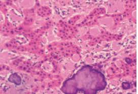 Tumors in general, a comparison and contrast of the histologic growth patterns of benign and malignant thyroid neoplasms seemed indicated. Diagnosis And Management Of Common Oral And Maxillofacial Lesions Intechopen