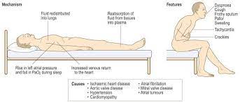 Paroxysmal nocturnal dyspnea or paroxysmal nocturnal dyspnoea (pnd) is an attack of severe shortness of breath and coughing that generally occurs at night. Paroxysmal Nocturnal Dyspnea Features And Mechanism Signs Of Heart Failure Symptoms Heart Failure