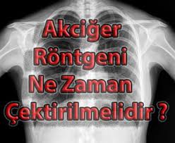 Sagligim Akciger Rontgeni Hangi Durumlarda Cektirilmelidir Saglik