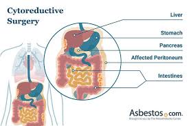 The search could help in identifying the suitable patients for the trials. Peritoneal Mesothelioma Causes Treatment Survival Rates