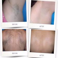 Veet hair removal cream for men. Soprano Ice Laser Hair Removal Near Me Radiant Living