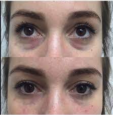 Periorbital Dark Circles The Beauty And Cosmetic Clinic 70 Pitt St