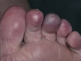 Rarely, people with a bone sarcoma may have symptoms such as fever, generally feeling unwell, weight loss, and anemia, which is a low level of red blood cells. Blue Toe Syndrome Dermnet Nz