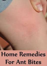 Ant Bites That Look Like Mosquito Bites Home Remedies For Ant Bites Ant Bites Home Remedies For Ants Ant Bites Relief