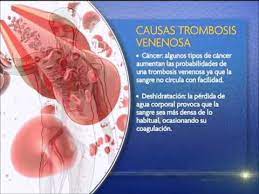 Check spelling or type a new query. Causas De Una Trombosis Venosa Youtube