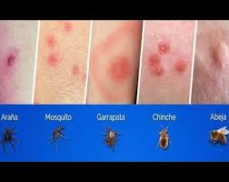 We did not find results for: Como Identificar Picaduras Y Mordeduras De Insectos Mont Medi