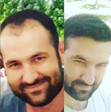 Trend Hair Corlu Sac Ekimi Sac Ektirme Corlu Cerkezkoy Sakal Biyik Fue Teknigi Biyiklar Cilt Urunleri Sakal