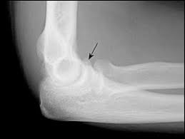 Image result for Coronoid Process Fracture