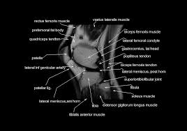 These muscles work in groups to flex, extend and stabilize the extending along the anterior surface of the thigh are the four muscles of the quadriceps femoris group (vastus lateralis, vastus medialis, vastus. Mri Knee Anatomy Knee Sagittal Anatomy Free Cross Sectional Anatomy