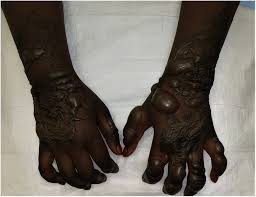 Henna body art has been a celebratory tradition in many countries for centuries. Allergic Contact Dermatitis To A Henna Tattoo Journal Of Emergency Medicine