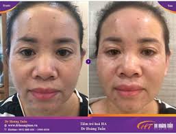 Tiêm HA trẻ hóa da