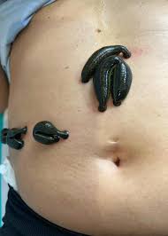 Perfil de Pijavica lekárska