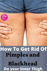 Avoid scrubbing your thighs with a harsh scrubber. Why Do You Get Pimples And Blackheads On Inner Thighs In 2021 Inner Thigh Bumps Inner Thigh Pimples Inner Thigh