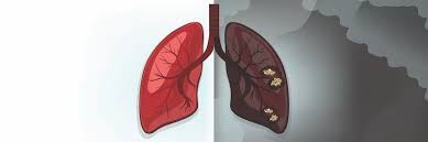 If you have symptoms that do not get better after a few weeks, see your doctor so that problems can be diagnosed and treated as early as possible. Immunotherapy Plus Chemo Benefits In Lung Cancer Neoadjuvant Treatment Cancer World Magazine