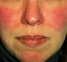 Pin On Rosacea