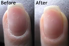 It makes sense that the filing of the nails and then the application of glues and acrylic shrink up and pull on the nails and thats what makes them. Bee Polished Make Over May Rehab Your Nails How To Remove Acrylics Remove Acrylic Nails Nails After Acrylics Nail Repair
