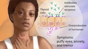 It frequently results in and is the most common cause of hyperthyroidism. What Is Graves Disease And How Treated Thyroid Be Informed