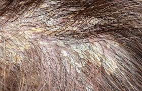 Regular cleansing agents and surfactants cannot remove silicone buildup from hair. Scalp Buildup Causes Treatment And Prevention