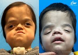 Craniofacial Reconstruction Before & After Photos