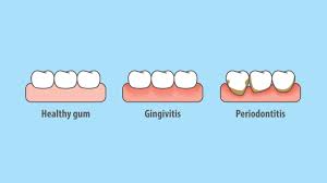 Gingivotomía, ae f glandŭla, ae f glossectomía, ae f. 5 Warning Signs Of Gum Disease That You Should Look Out For
