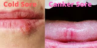 Check spelling or type a new query. Are Canker Sores Contagious