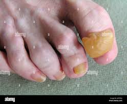 Image result for Onychogryphosis feet