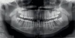 (a) multiple confluent opacities in all four jaw quadrants. Scielo Brasil Oral Management Of A Patient With Cemento Osseous Dysplasia A Case Report Oral Management Of A Patient With Cemento Osseous Dysplasia A Case Report