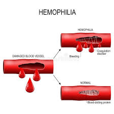 Als je hemofilie hebt, krijg je snel bloedingen. De Hemofilie Is Coagulatiewanorde Vector Illustratie Illustratie Bestaande Uit Menselijk Beschadigd 108892946