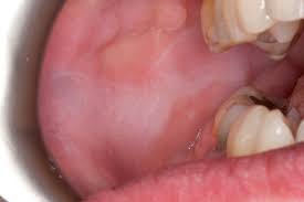 Zu einer entzündung des zahnmarks, also dem inneren weichgewebeanteil des zahns, kommt es meist aufgrund einer sich ausbreitenden karies. Wund Im Mund Es Ist Zum Gluck Nicht Immer Krebs Zwp Online Das Nachrichtenportal Fur Die Dentalbranche