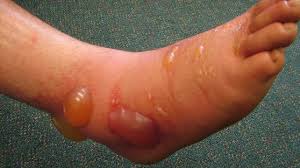 Image result for Rhus Dermatitis