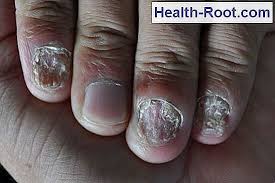 Psoríase é uma doença crónica da pele, muito comum e não contagiosa. A Psoriase Sob As Unhas Pode Ser Confundida Com Fungos Nas Unhas Doenca Sintomas Tratamento 2021