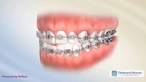 Oral anesthetics desensitize your teeth and gums so you don't feel the discomfort of shifting teeth so acutely. What Is Open Bite Symptoms Diagnosis And Treatment