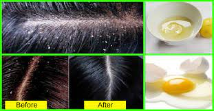 Massaging your hair with coconut oil, argan oil, peppermint oil, and castor oil can help reduce hair fall and stimulate hair growth ( 1 ). How To Get Rid Of Dandruff Effective Tips And Remedies