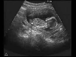 Ultrasound Fetal Response To Alcohol Fetal Alcohol Syndrome Youtube