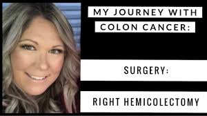 My Journey With Colon Cancer