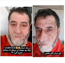 بیماری_پیسی بیماری پیسی ویا #ویتلیگو بیماری است که باید به‌طور کلی درمان و  ریشه کن شود اگر جلوی این بیماری گرفته نشود در طول زمان همین لکه‌های سفید در  تمام بدن سرایت