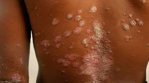 Image result for skin rash similar to scabies