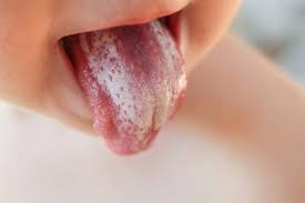 Lengua Blanca Causas Y Tratamiento Clinica Dental Soria Vizcaino