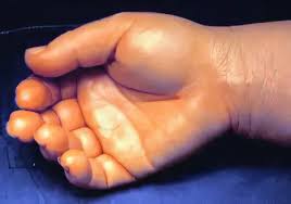 Image result for phlegmon of hand)