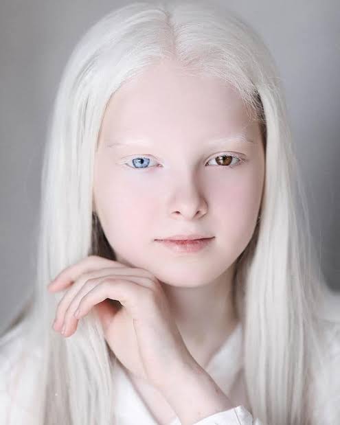 Fraternal twins with albinism due to genetics