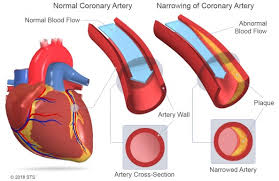 However, coronary heart disease , or chd, is actually a result of coronary artery disease, or cad with coronary artery disease, plaque first grows within the walls of the coronary arteries until the. Coronary Artery Disease The Patient Guide To Heart Lung And Esophageal Surgery