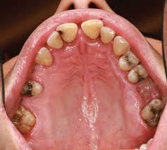 Image result for oral thrush symptoms roof of the mouth