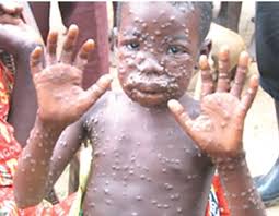 Monkeypox, viral disease of both animals and humans that causes symptoms similar to those of smallpox, though monkeypox was first identified in laboratory monkeys in 1958. Who Confirms Three Cases Of Monkey Pox In Nigeria Tribune Online