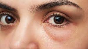 Was Wirklich Geschwollene Augen Und Tranensacke Verursacht Youtube