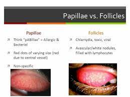 Papilla V S Follicle Avascular Red Dots Viral