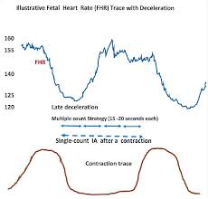 Image result for Late Deceleration