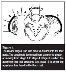 Image result for Risser Sign